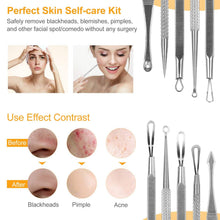 Load image into Gallery viewer, 5-Piece Set: Blackhead Remover Kit Stainless Steel Popping Zit Remover
