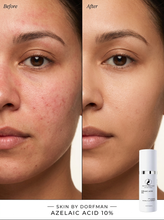Load image into Gallery viewer, Azelaic Acid 10%
